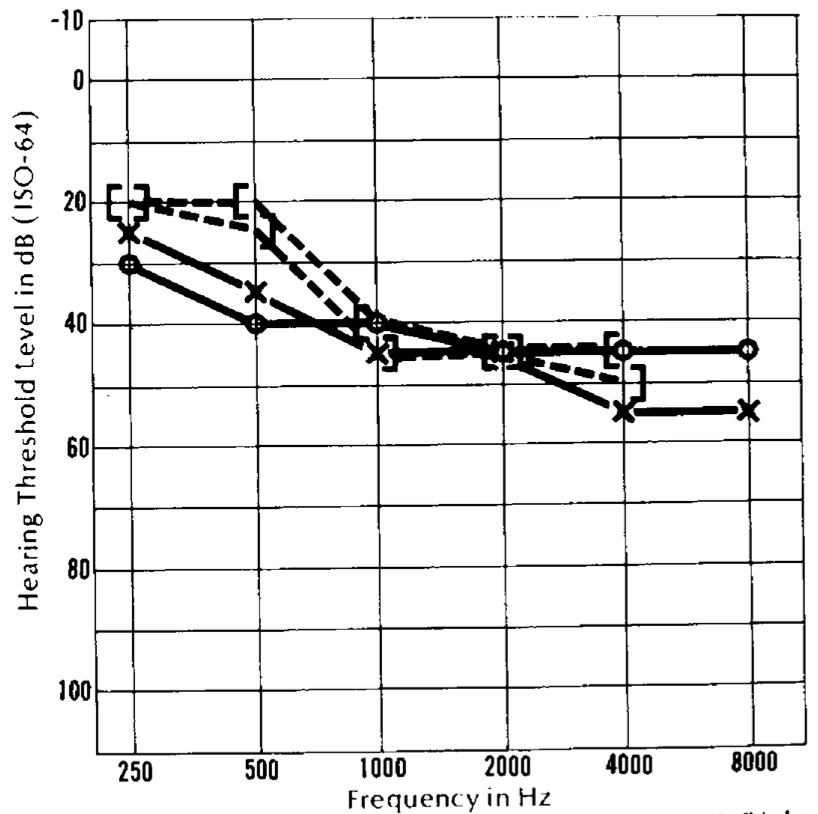 Figure: Audiogram from a 46-year-old woman with Chiari 1 malformation showing approximately symmetrical, high greater than middle frequency sensorineural hearing loss.  From Rydell et al. (1971).