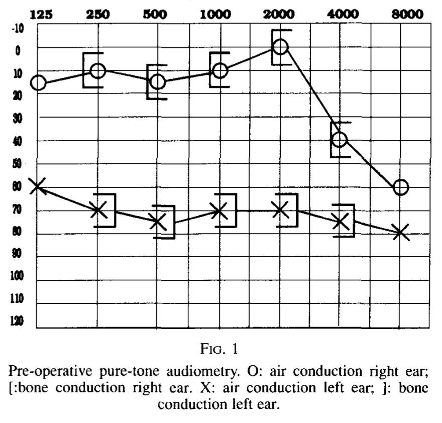 Figure: Audiogram of a patient with Chiari 1 malformation showing left-sided moderate to severe sensorineural hearing loss.  From Albers and Engels (1993).