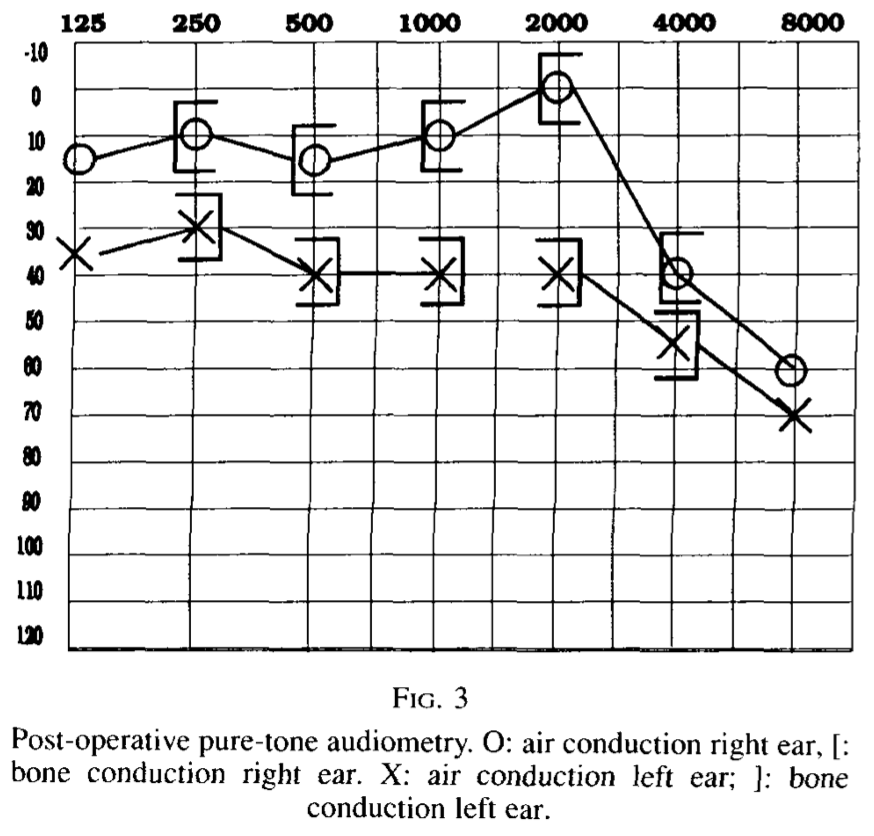 Figure: Audiogram of the same patient with Chiari 1 malformation one year after surgical decompression, showing some improvement in the left-sided sensorineural hearing loss.  From Albers and Engels (1993).
