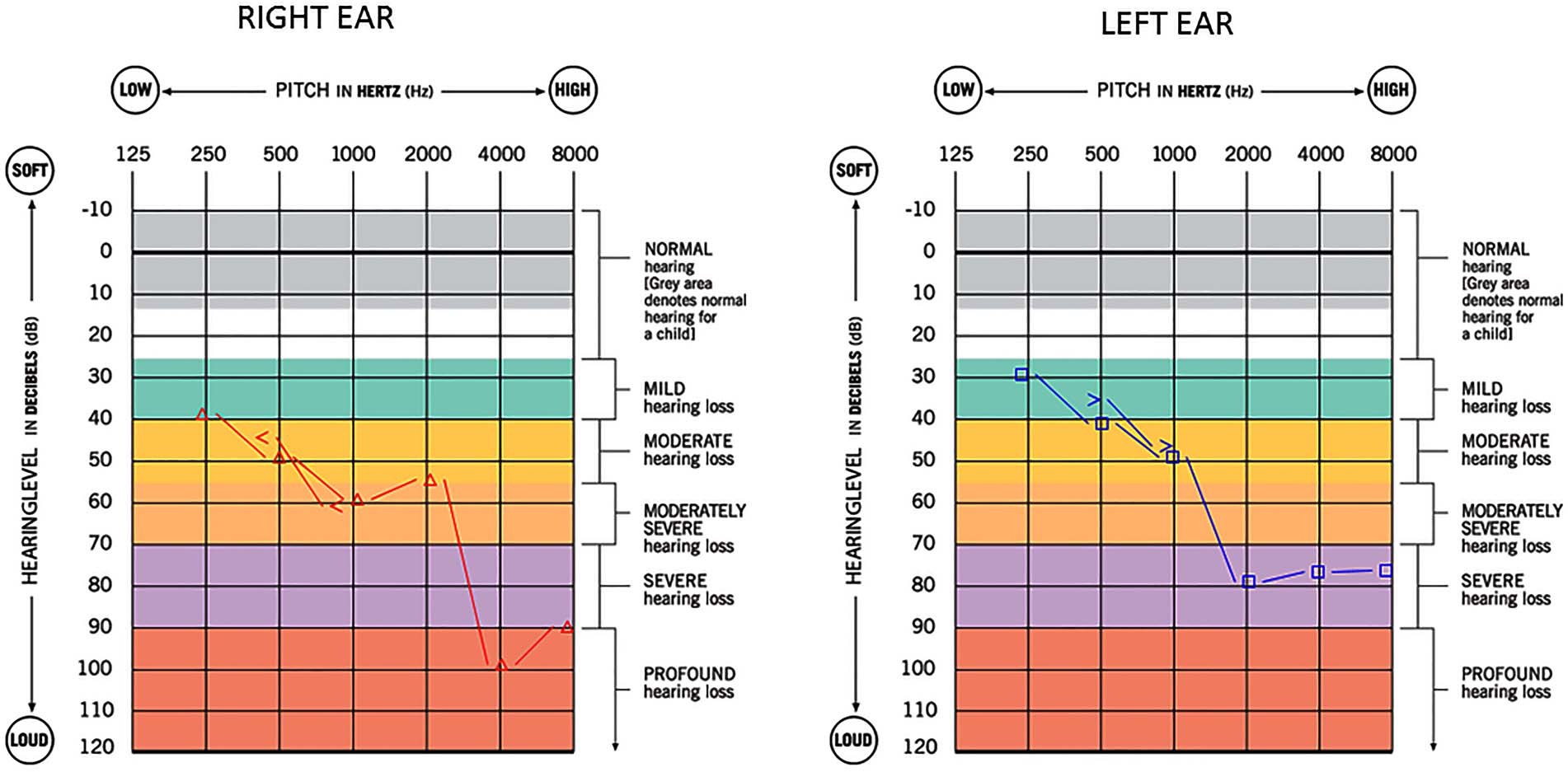 Figure: Audiometry in a 45-year-old male with testicular seminoma whose paraneoplastic syndrome included bilateral, modestly asymmetrical, high greater than low frequency sensorineural hearing loss.  From Kattah et al. (2021).