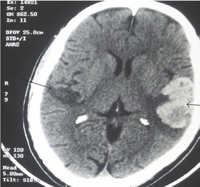 Figure: Axial CT head showing infarcts in bilateral temporal lobes with haemorrhagic transformation on left.  From Narayanan et al. (2017),