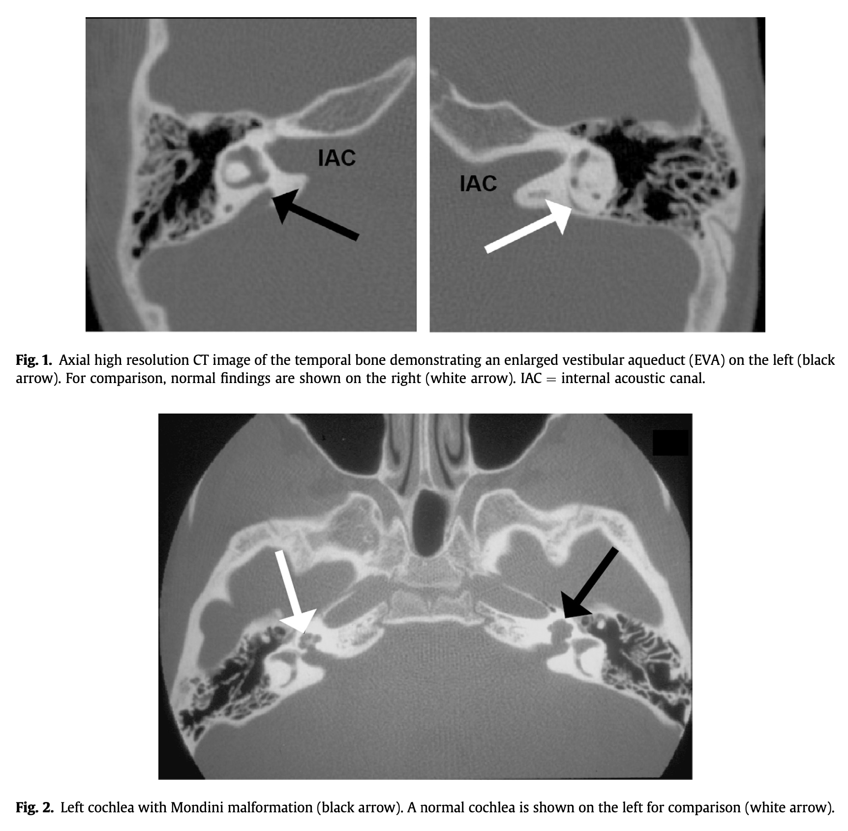 Figure: Axial CT images.  Pendred syndrome often manifests with a large vestibular aqueduct (upper left panel) and incompletely formed cochlea (lower panel).  From Wemeau et al. (2017).