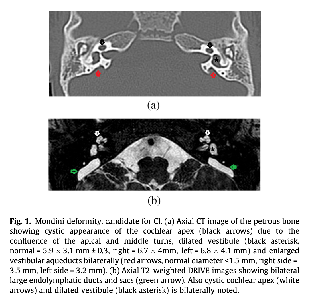 Figure: Axial images from temporal bone CT (top panel) and MRI of the internal auditory canals (bottom panel) of a patient with bilateral Mondini dysplasia.  From Al-Rawy et al. (2018).