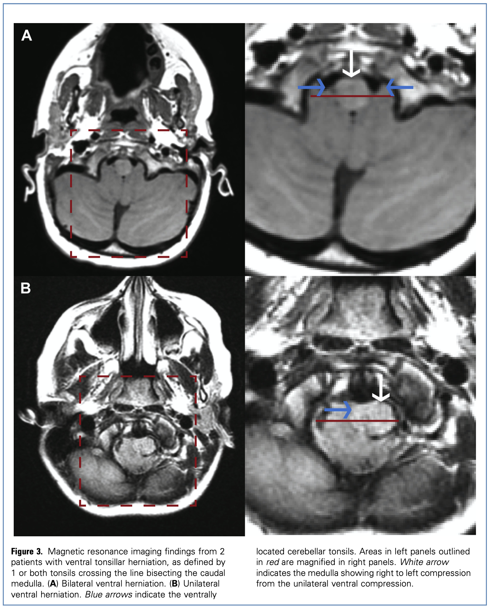 Figure: Axial MRI images demonstrating ventral herniation — wrapping of the cerebellar tonsils anteriorly around the medulla — in patients with Chiari type 0.5.  From Morgenstern et al (2020).