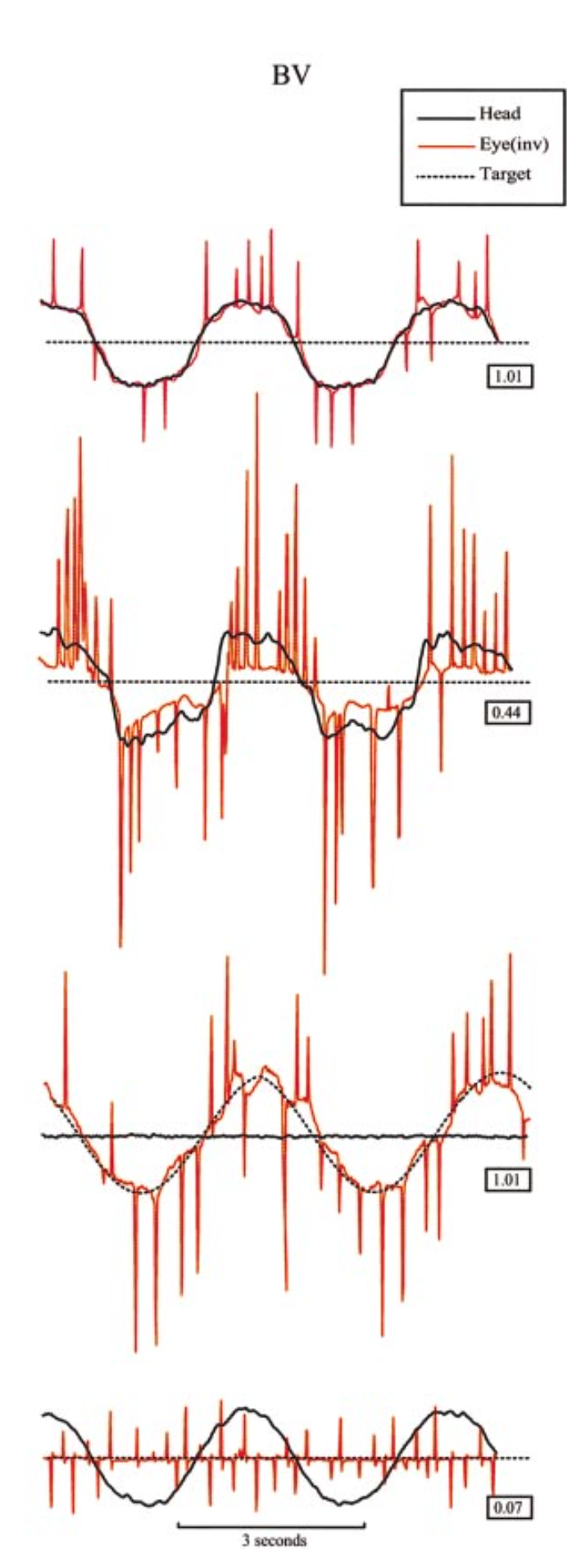 Figure: Bilateral vestibular loss patients, testing of VVOR (visual vestibulo-ocular reflex), VOR (vestibulo-ocular reflex), SP (smooth pursuit) and VORS (vestibulo-ocular reflex visual suppression).  From Migliaccio et al. (2004).