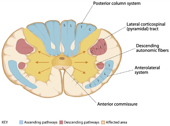 Figure: Central cord syndrome.  Adapted from Cho (2015).
