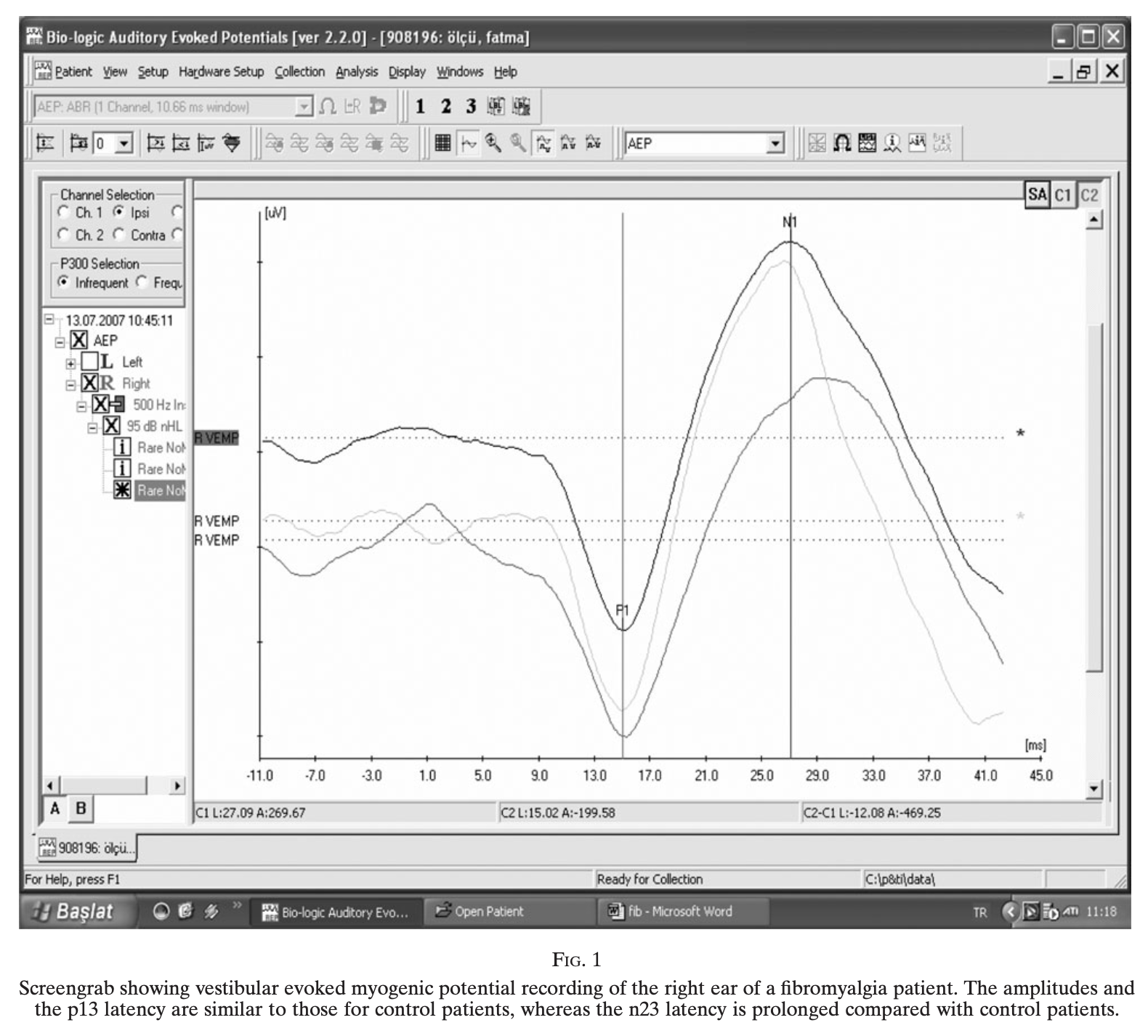 Figure: Cervical vestibular evoked myogenic potentials show delayed n23 latencies in patients with fibromyalgia compared to healthy controls.  From Bayazit et al. (2010).