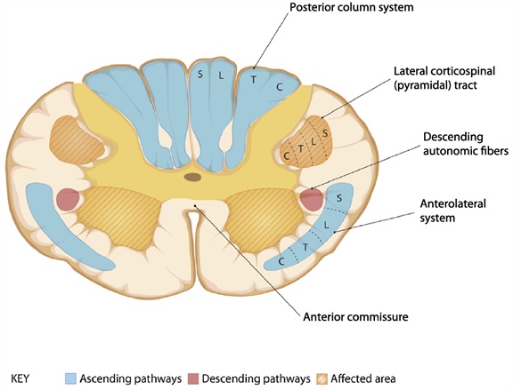 Figure: Combined anterior horn and corticospinal tract syndrome.  Adapted from Cho (2015).