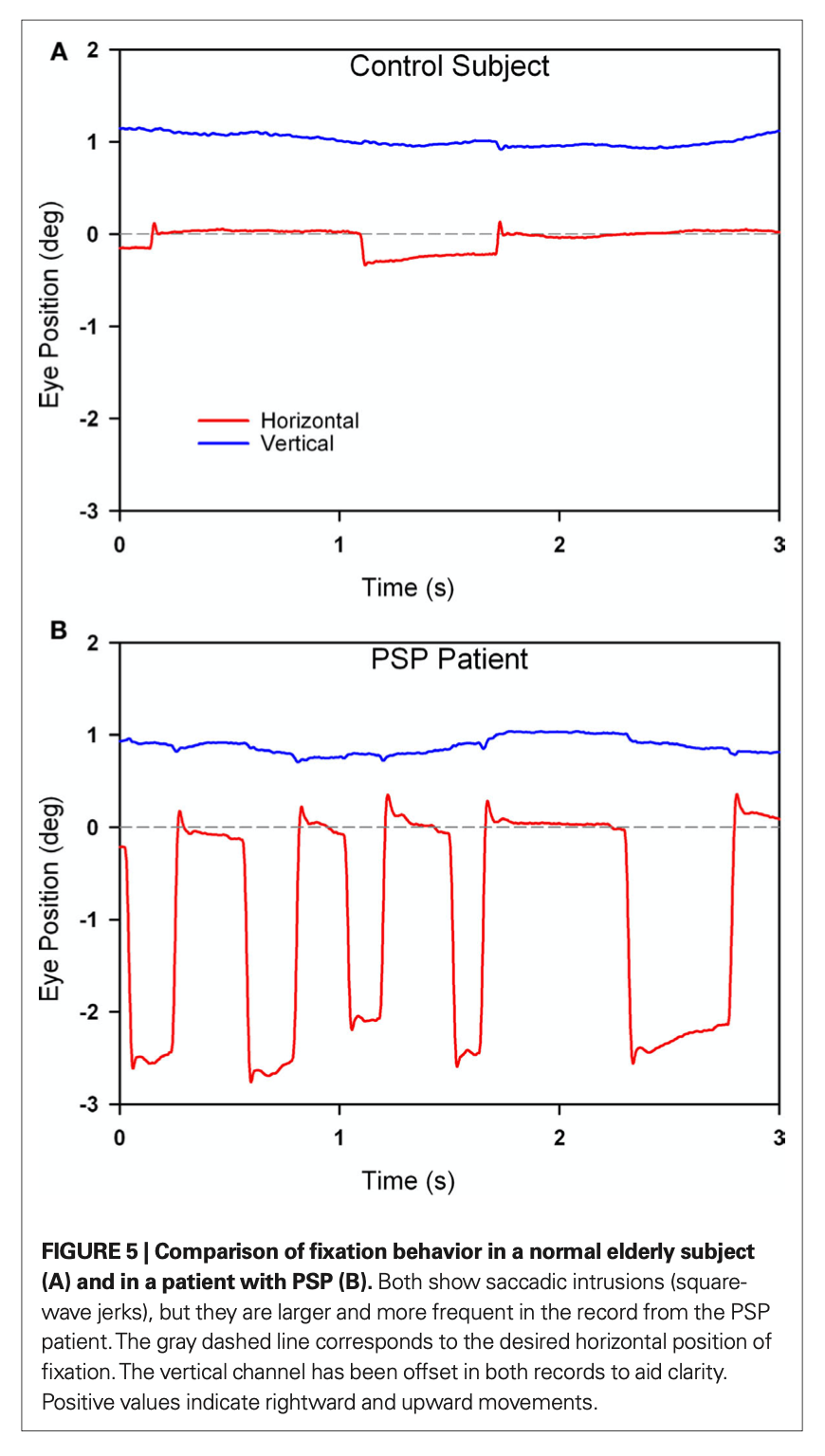 Figure: Comparison of refixation saccades in a healthy individual (top panel) with square wave jerks in a patient with progressive supranuclear palsy (bottom panel).  From Chen et al. (2010).