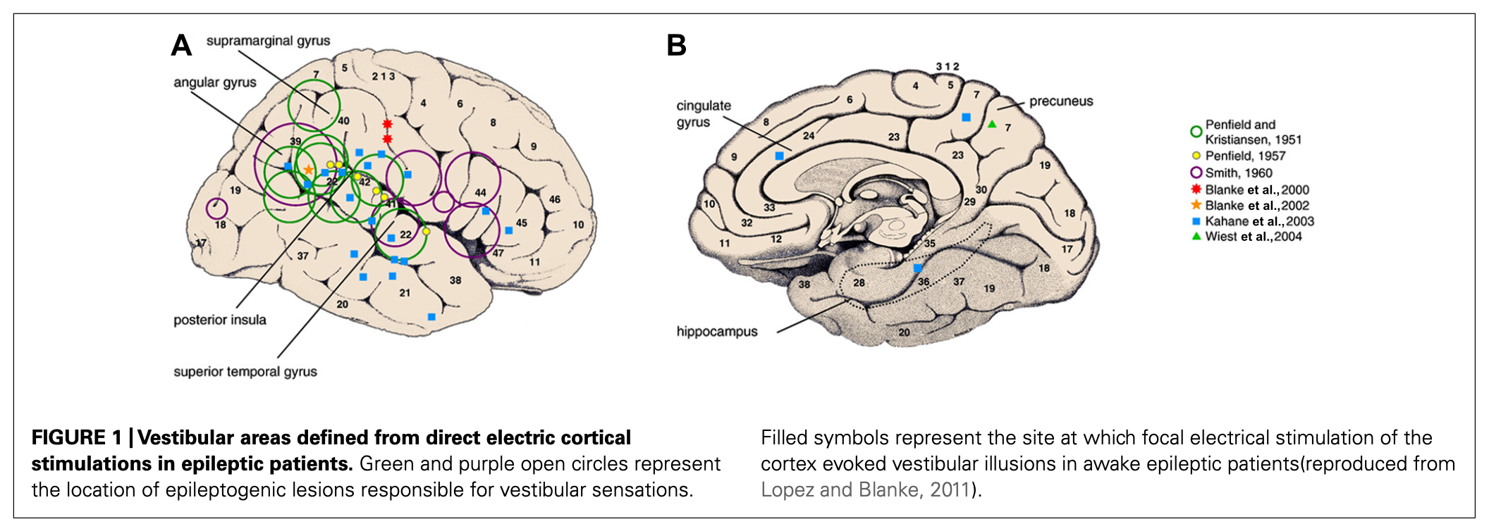 Figure: Compilation from multiple cortical stimulation studies of epileptic vertigo.  From Hewitt et al. (2013).