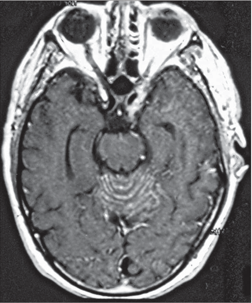 Figure: Contrast enhancement in the sulci of the cerebellar vermis in a patient with a paraneoplastic cerebellar syndrome from non-Hodgkin's lymphoma with anti-Tr antibodies.  From Dalmau et al. (2008).