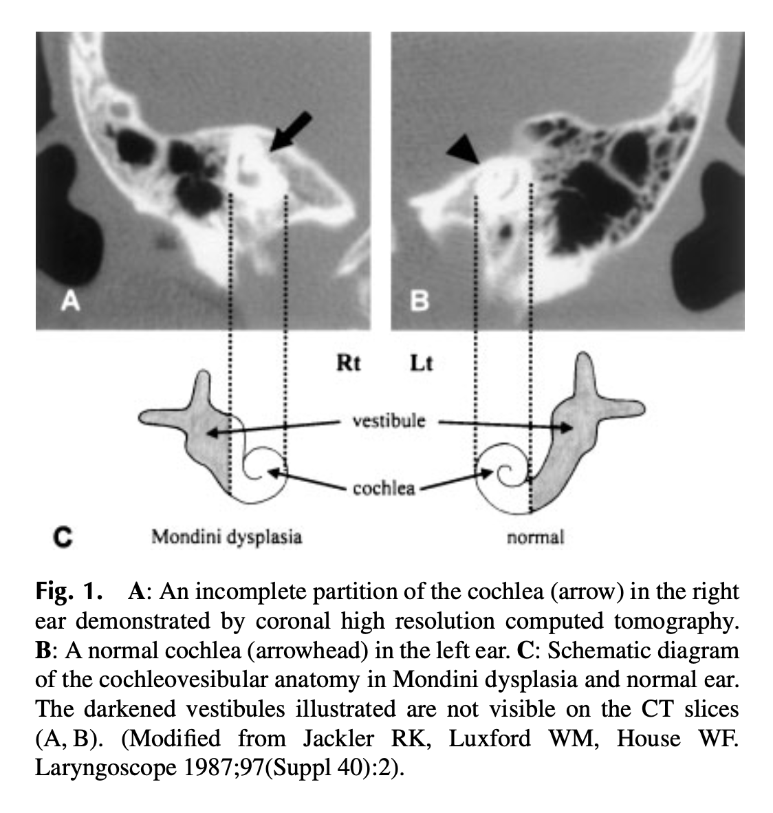 Figure: Coronal CT images of bilateral Mondini dysplasia with corresponding schematic illustrations.  From Kitazawa et al. (2004).