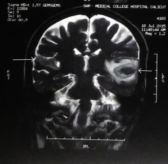 Figure: Coronal MRI brain showing infarcts in bilateral Heschl gyri.  From Narayanan et al (2017).