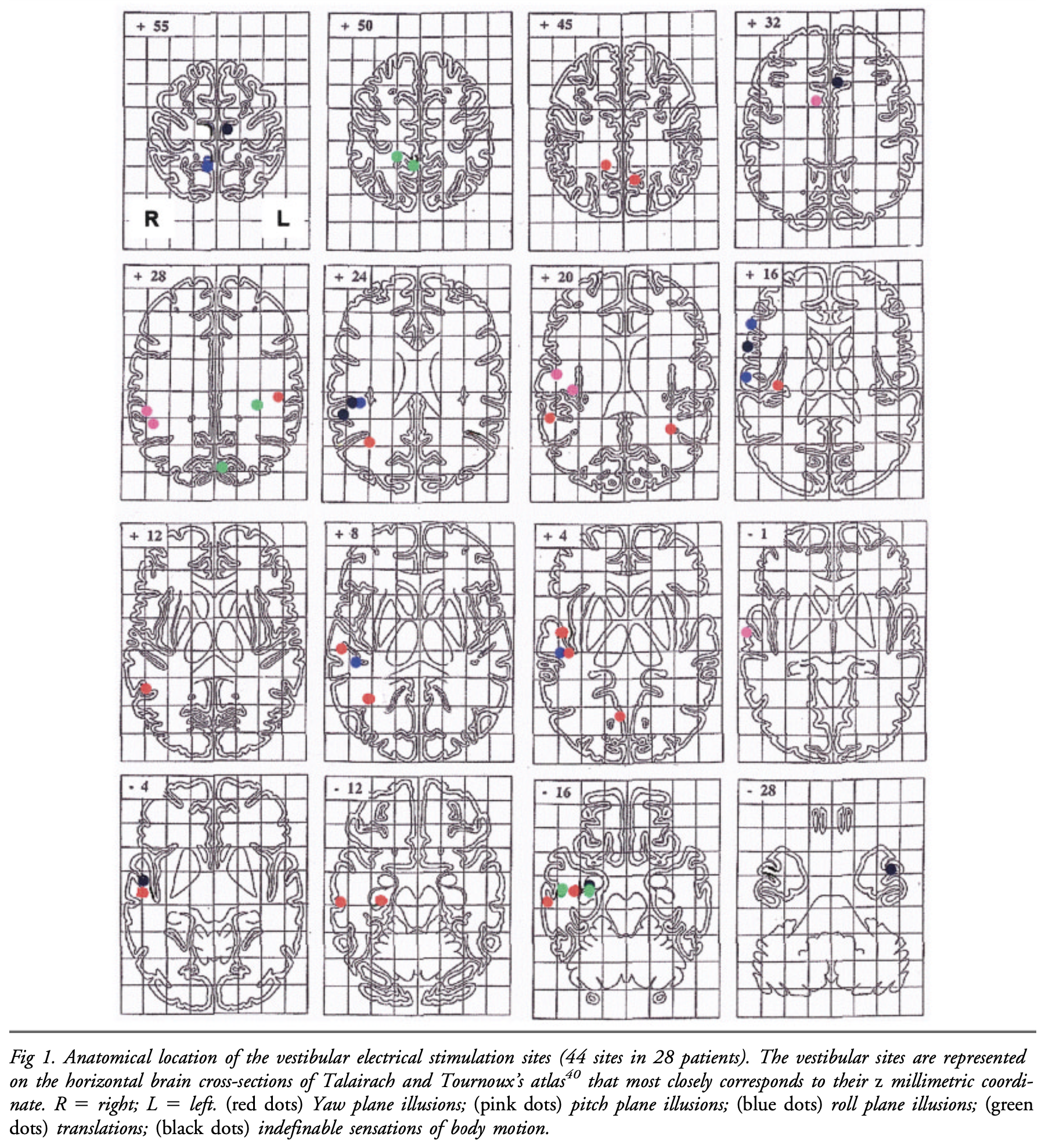 Figure: Distribution of vetibularly-sensitive sites in the study by Kahane et al. (2003).