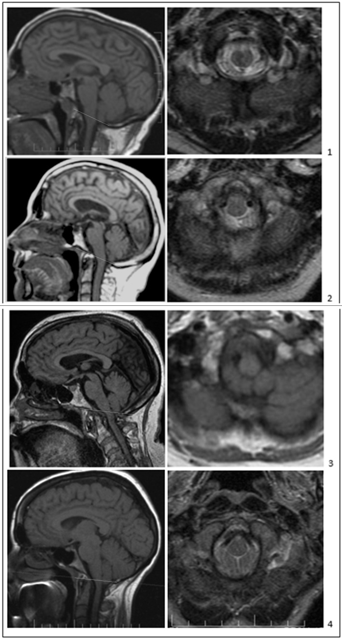 Figure: Examples of Chiari malformation type 0, from Bogdanov et al. (2022).