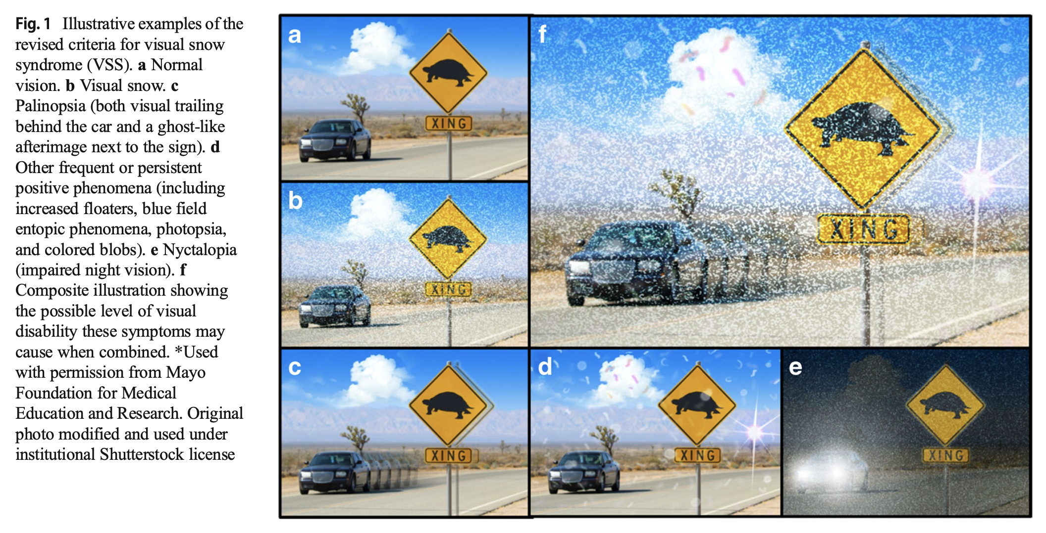 Figure: Examples of some of the visual phenomena experienced in visual snow syndrome.  From Metzler and Robertson (2018).