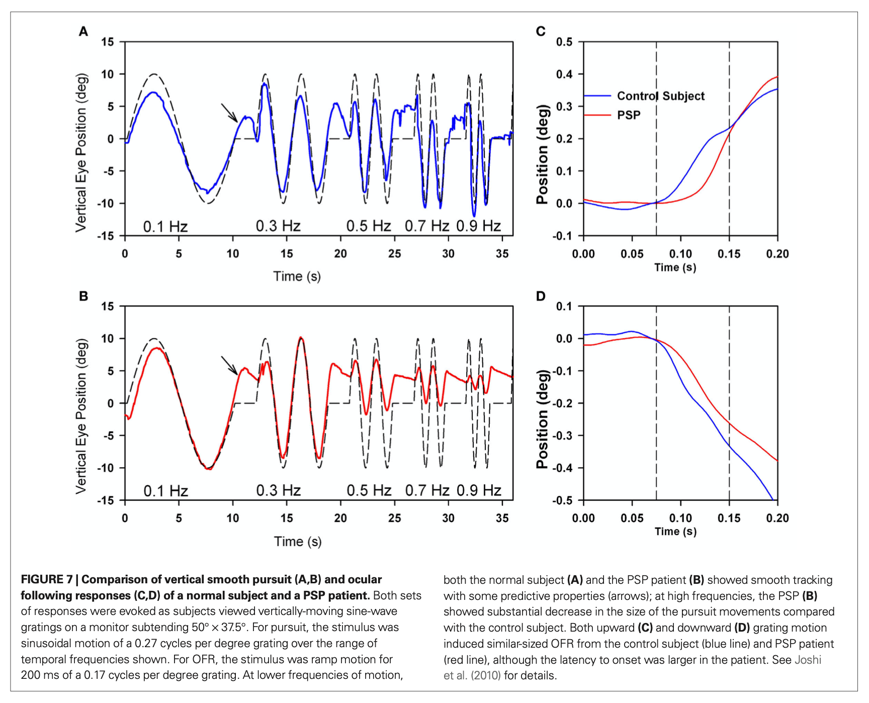Figure: Gain of vertical smooth pursuit in a normal individual (top panels) and in a patient with progressive supranuclear palsy (bottom panels).  From Chen et al. (2010).