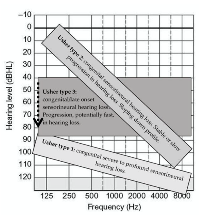 Figure: General patterns of hearing loss across the three main types of Usher syndrome.  From Castiglione and Moller (2022).