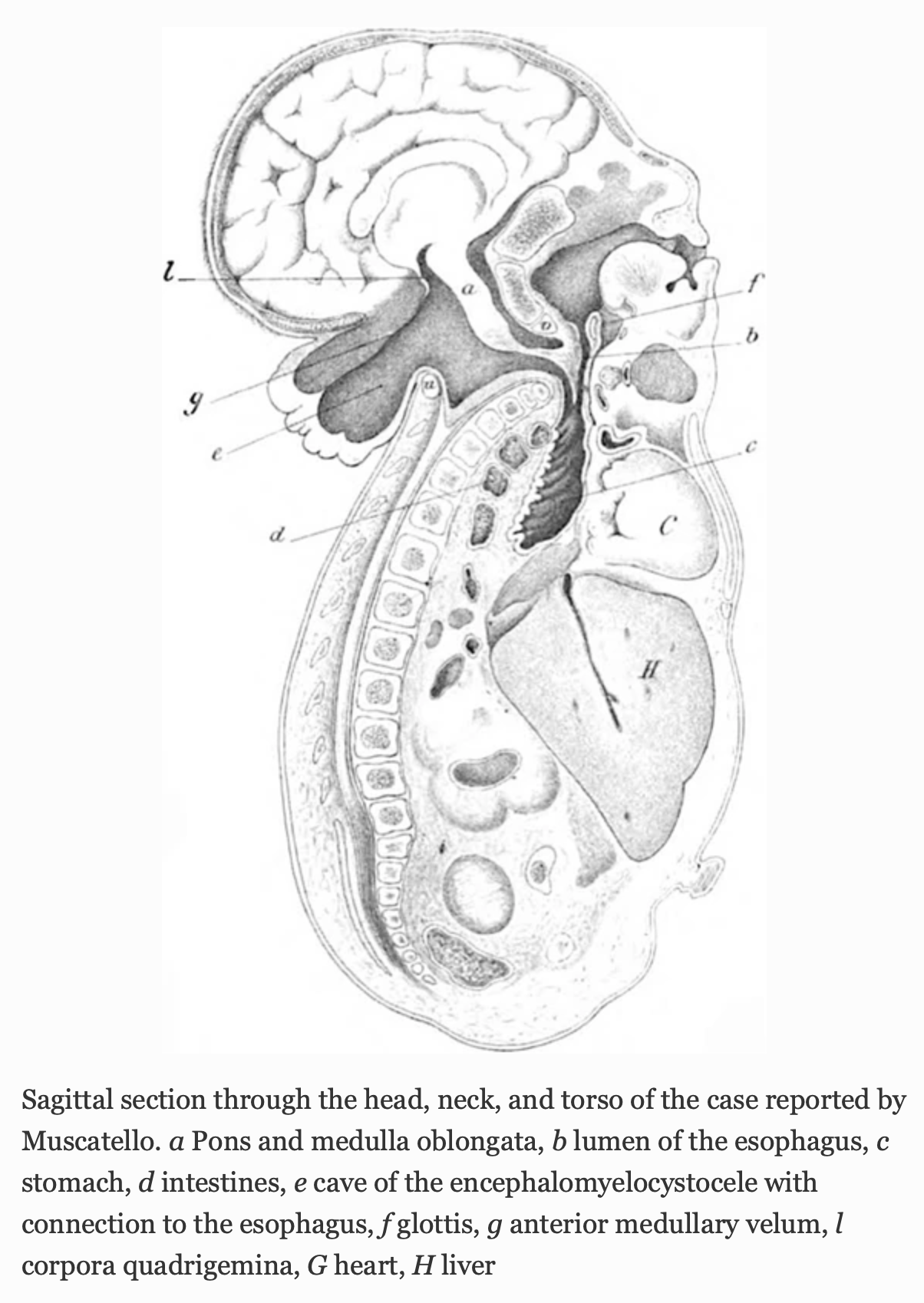 Figure: Giuseppe Moscatello's (1894) illustration of a variant of a Chiari malformation type 3.  Fisahn et al. (2016) propose calling this "Chiari 3.5."