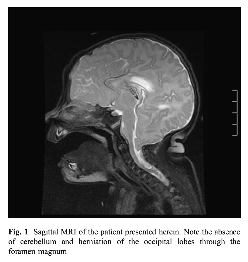 Figure: Herniation of the occipital lobe through the foramen magnum, and absence of the cerebellum.  Tubbs et al. (2012) proposed designating this a Chiari malformation type 5.