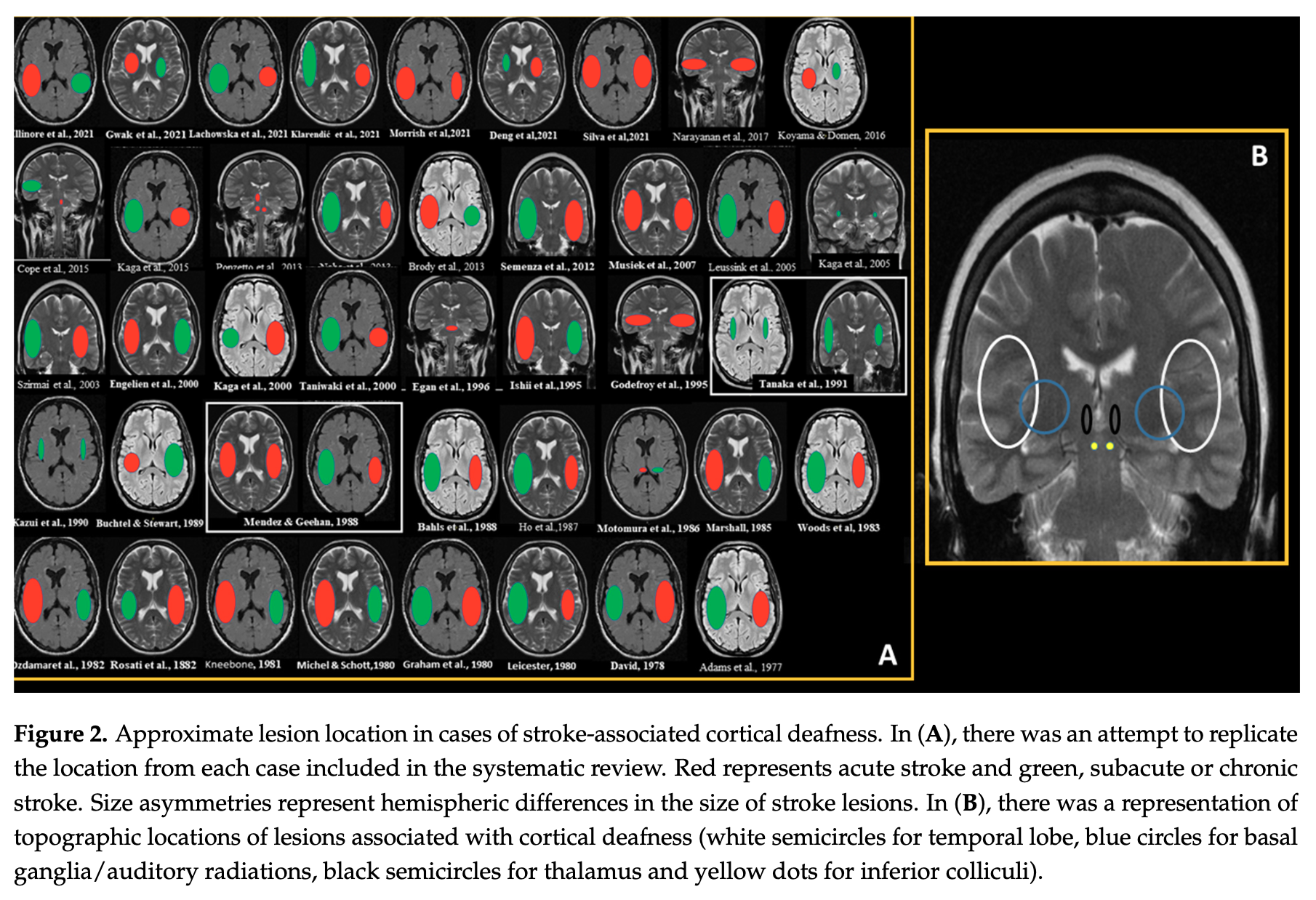 Figure: MRIs from 46 patients with infarct-related deafness.  From Silva et al. (2021).