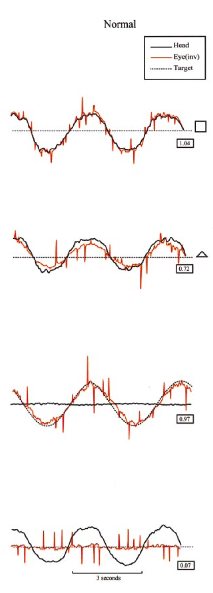 Figure: Normal subjects, testing of VVOR (visual vestibulo-ocular reflex), VOR (vestibulo-ocular reflex), SP (smooth pursuit) and VORS (vestibulo-ocular reflex visual suppression).  From Migliaccio et al. (2004).