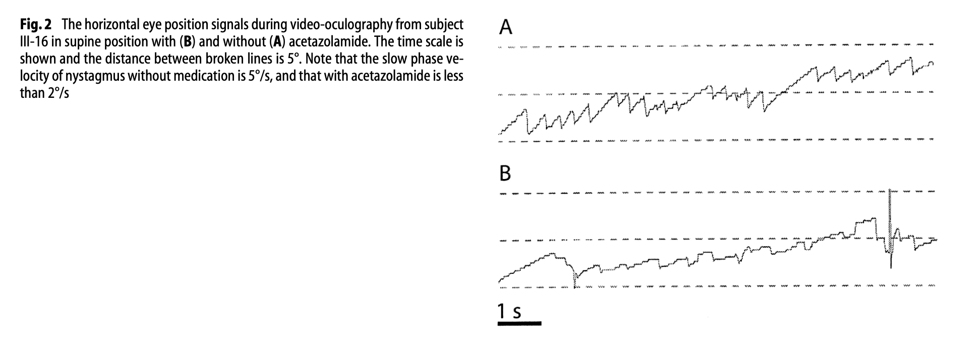 Figure: Nystagmographic tracings from a patient with genetically confirmed episodic ataxia type 2.  Panel A shows spontaneous left beat nystagmus of 5 deg/sec while the patient was off treatment.  Panel B shows reduction of the spontaneous left beat nystagmus to 2 deg/sec while the patient was on treatment with acetazolamide.  From Harno et al. (2004).