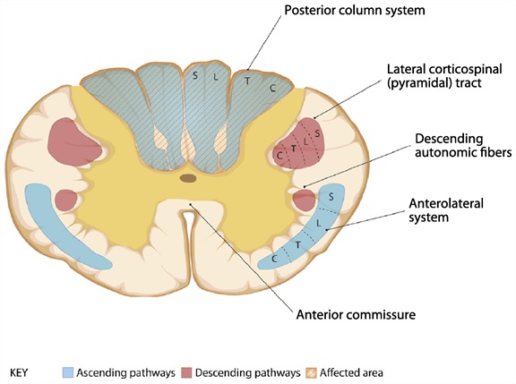 Figure: Posterior cord syndrome.  Adapted from Cho (2015).
