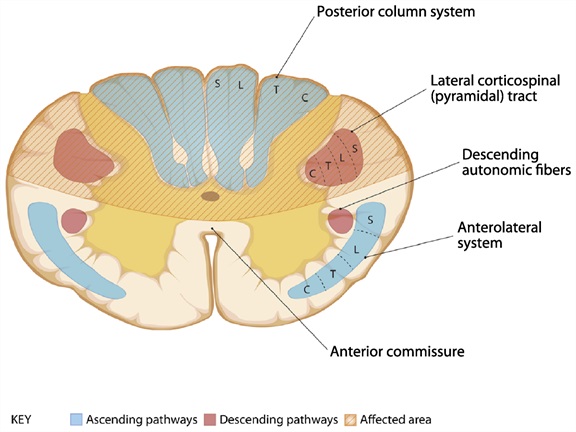 Figure: Posterolateral column syndrome.  Adapted from Cho (2015).