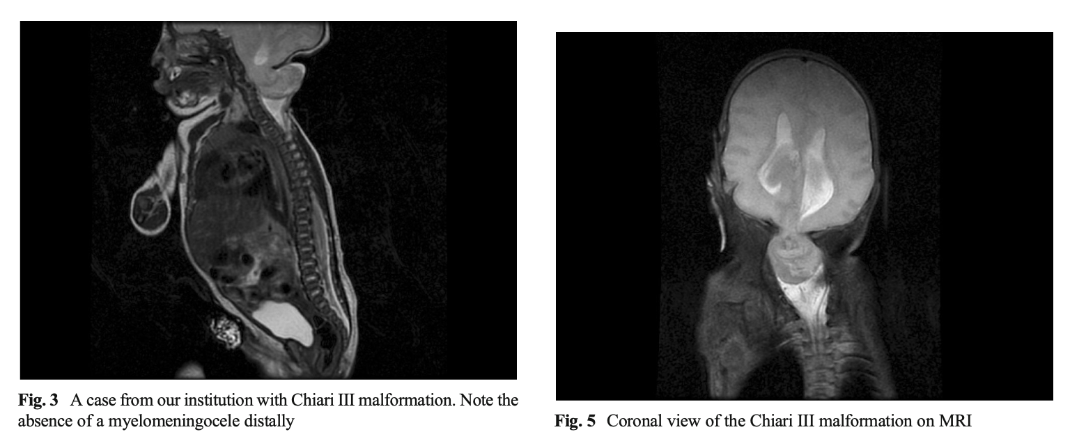 Figure: Sagittal (left panel) and coronal (right panel) views of a patient with a Chiari malformation type 3.  From Ivashchuk et al. (2015).