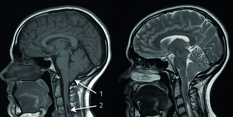 Figure: Sagittal MRI head images of a patient with Chiari 1 malformation, with T1-weighted (left) and T2-weighted (right) sequences. Arrows show (1) the cerebellar herniation and (2) the cervical cord syringomyelia.  From Piper et al. (2019).