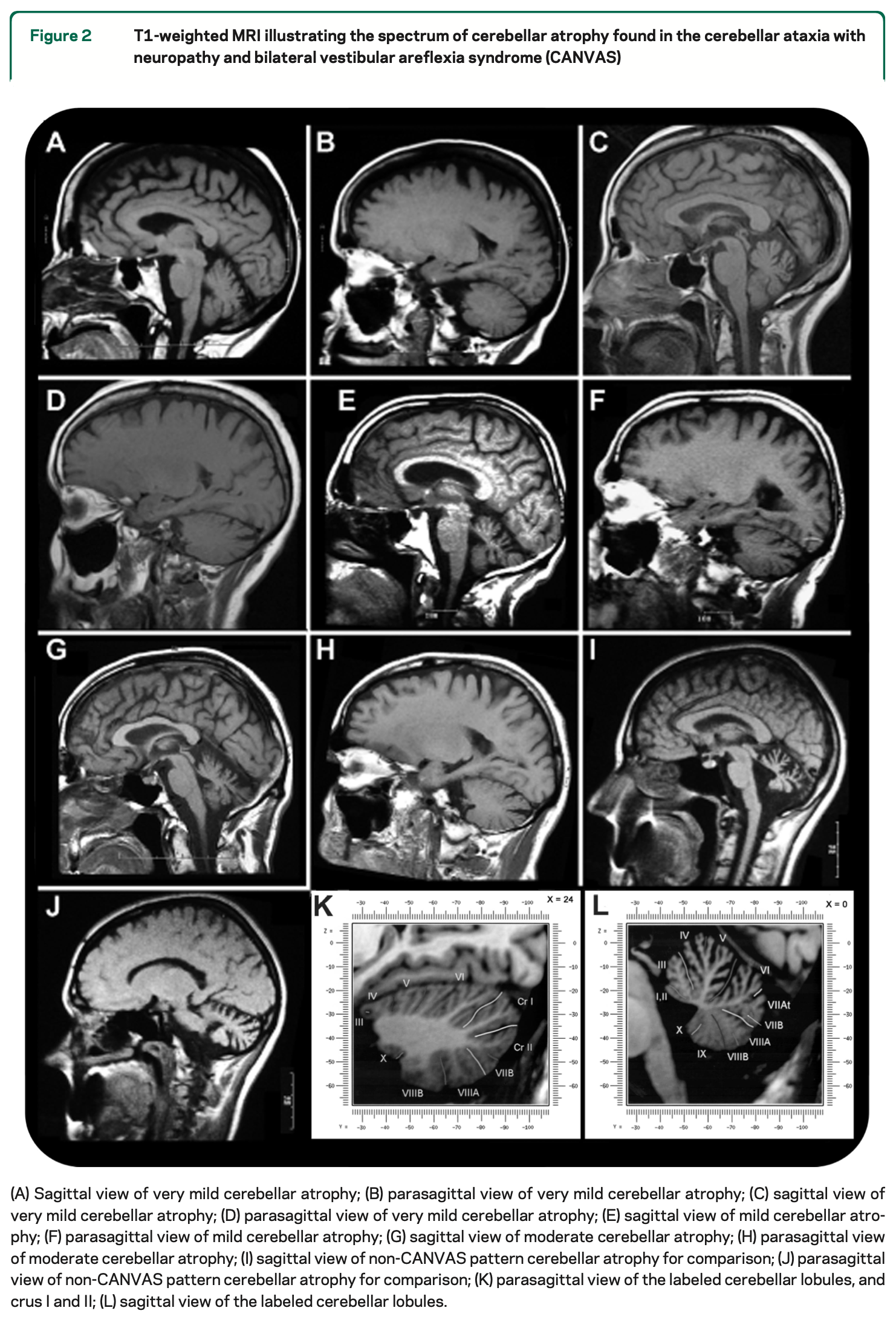 Figure: Sagittal sections from MRIs showing cerebellar atrophy in patients with CANVAS.  From Szmulewicz et al. (2011).