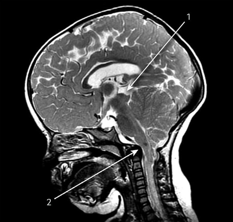 Figure: Sagittal T1-weighted MRI of an infant with Chiari 2 malformation showing (1) beaking of the tectal plate and (2) caudal displacement and compression of the brainstem.  From Piper et al. (2015).