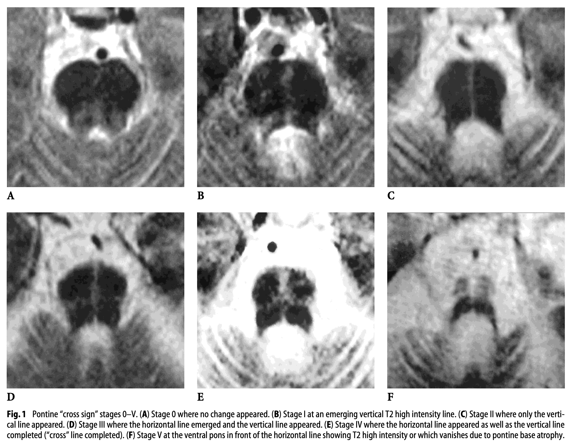 Figure: Serial axial T2 images at the level of the pons in a patient with multiple system atrophy showing appearance of the "hot cross buns" sign.  From Horimoto et al. (2002).