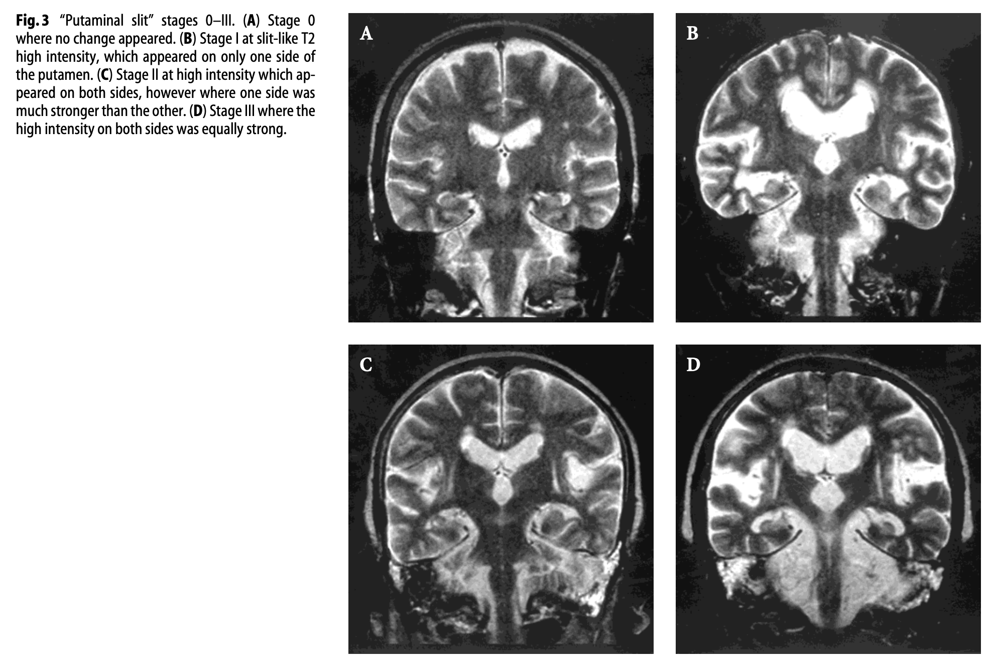 Figure: Serial T2 coronal MRI images demonstrating appearance of the “putaminal slit” sign in a patient with multiple system atrophy.  From Horimoto et al. (2002).