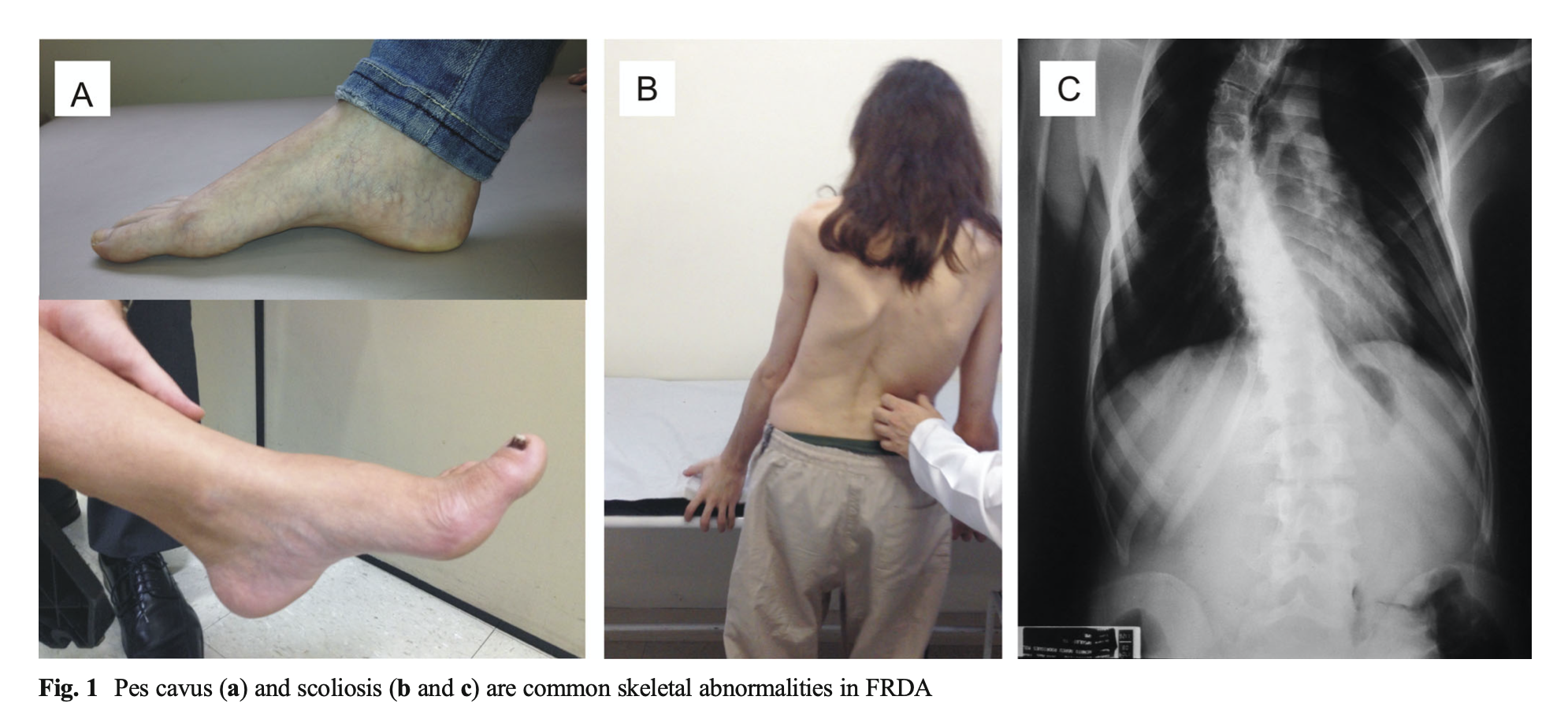Friedreich ataxia - Dizziness-Doctor.com