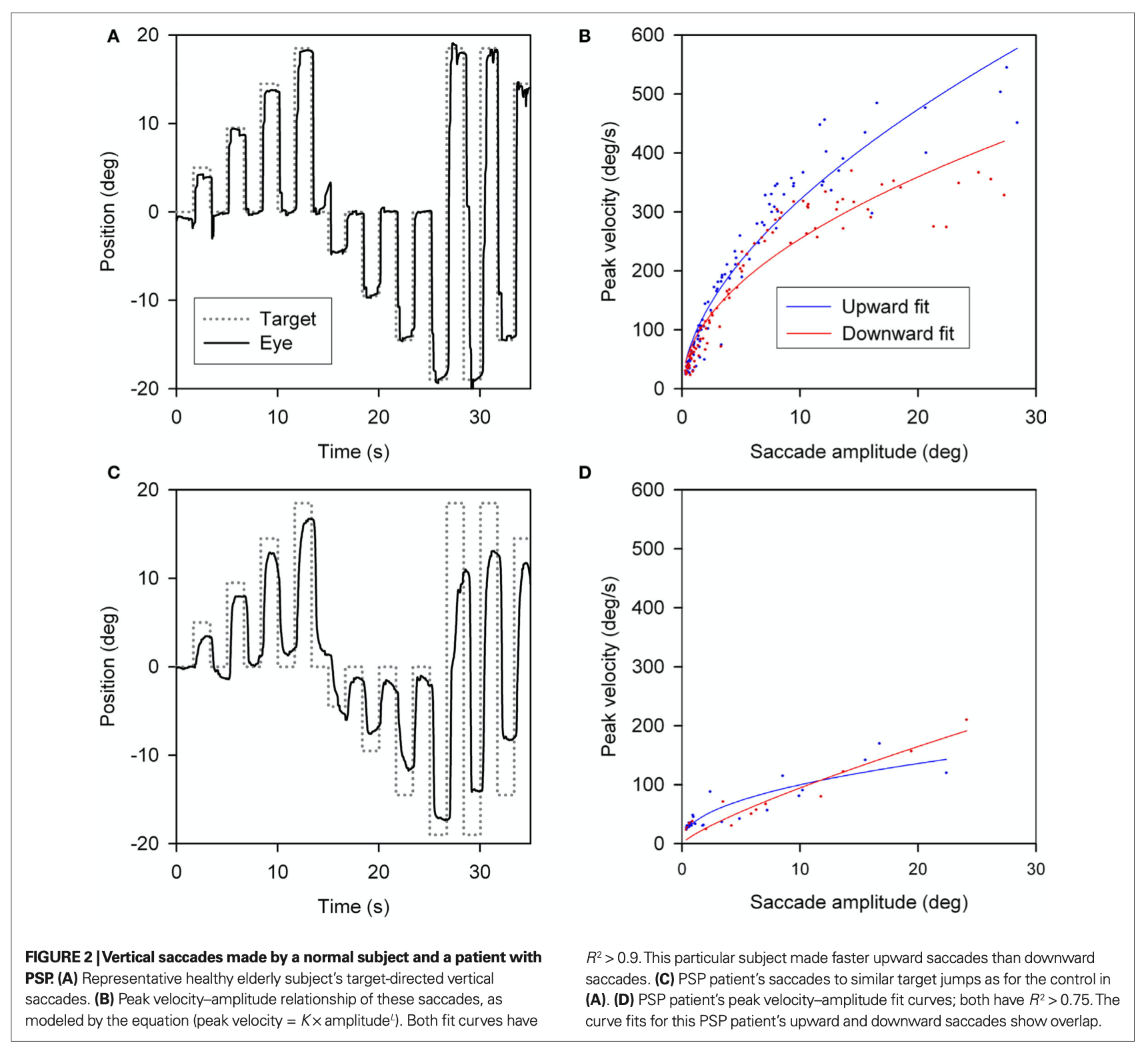 Figure: The top panels show normal vertical saccadic amplitude (left) and velocity (right) in a healthy person.  The bottom panels show vertical saccadic amplitude (right) and velocity (left) are reduced in a patient with progressive supranuclear palsy.  From Chen et al. (2010).