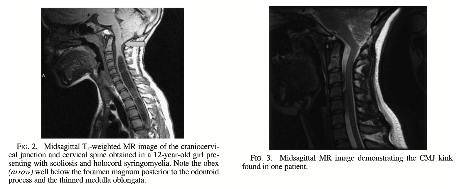 Figure: Two examples of Chiari malformation type 1.5.  From Tubbs et al. (2004).