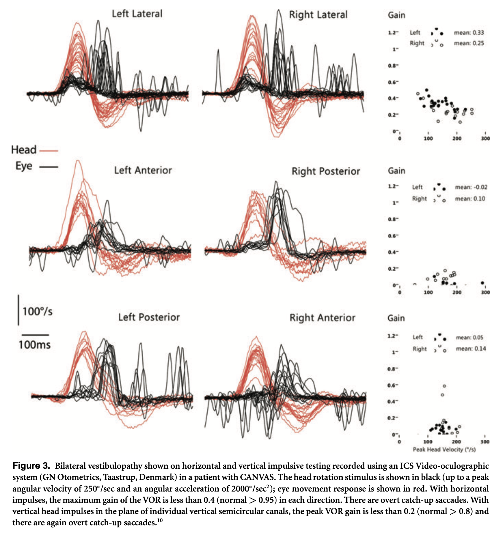 Figure: Video head impulse testing showing weakness of the vestibulo-ocular reflex in all 6 semi-circular canals in a patient with CANVAS.  From Szmulewicz et al. (2011).