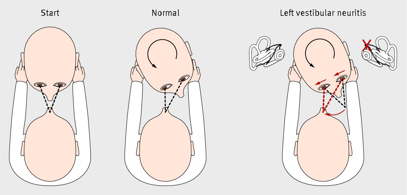 Figure: A top view schematic of the bHIT starting position (left panel), normal leftward bHIT (center panel) and abnormal leftward bHIT (right panel).  From Kaski and Bronstein (2012).