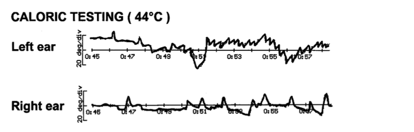 Figure: Asymmetrical caloric responses in a patient with superficial siderosis.  From Vibert et al. (2004).