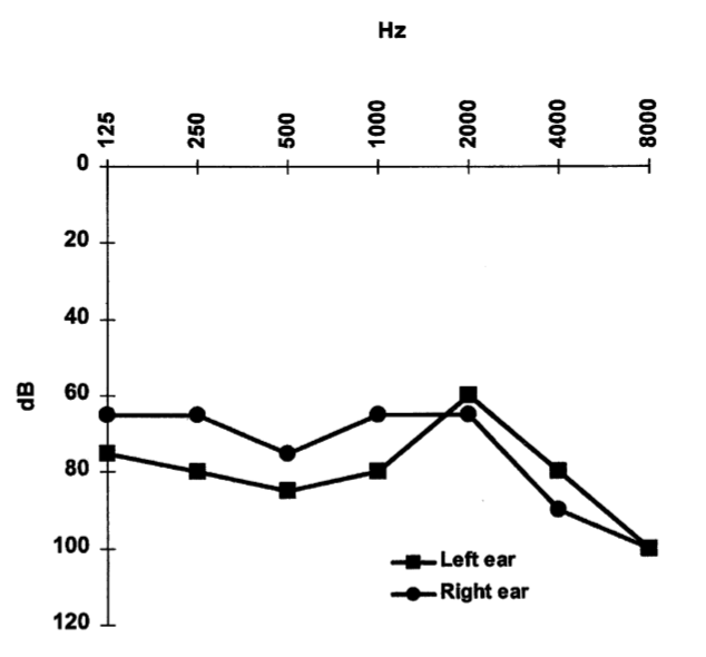 Figure: Audiogram from a patient with superficial siderosis showing an "across-the-board" hearing loss, with modest asymmetry in the low and middle frequencies.  From Vibert et al. (2004).