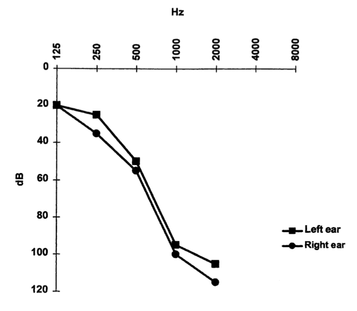 Figure: Audiogram from a patient with superficial siderosis showing approximately symmetrical middle and high frequency hearing loss.  From Vibert et al. (2004).