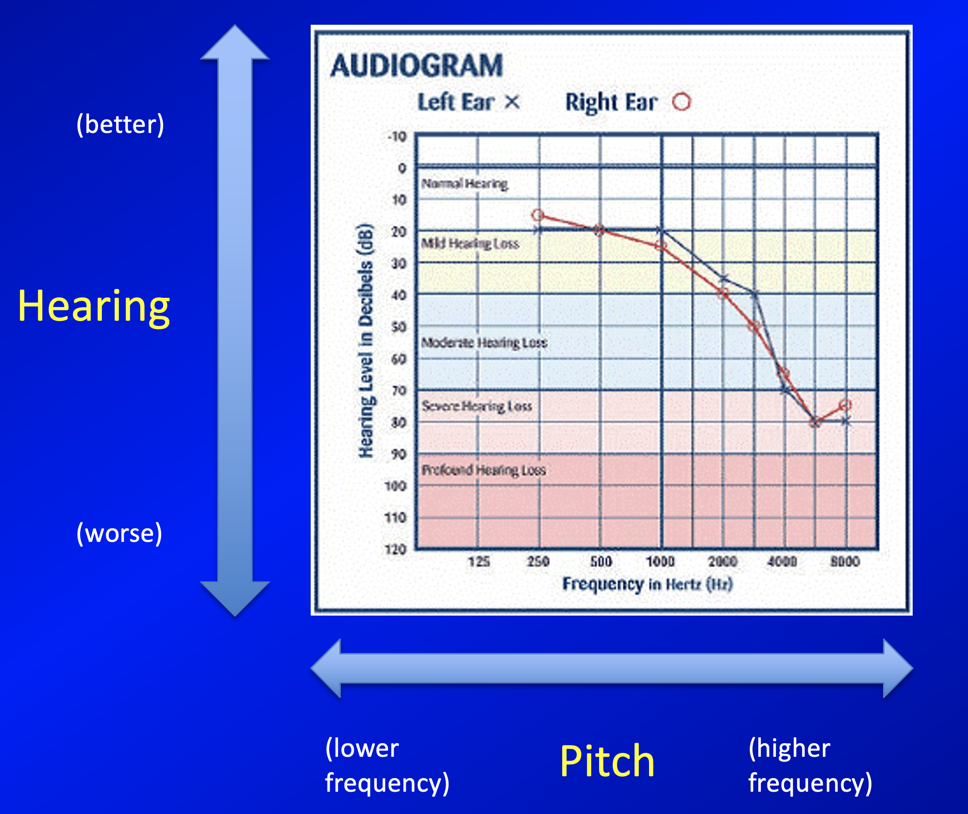 Figure: Audiogram showing normal hearing in the low frequencies, sloping down to approximately symmetrical severe hearing loss in the high frequencies.
