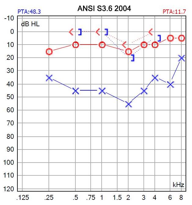 Figure: Audiogram showing normal hearing on the right, and conductive hearing loss on the left.