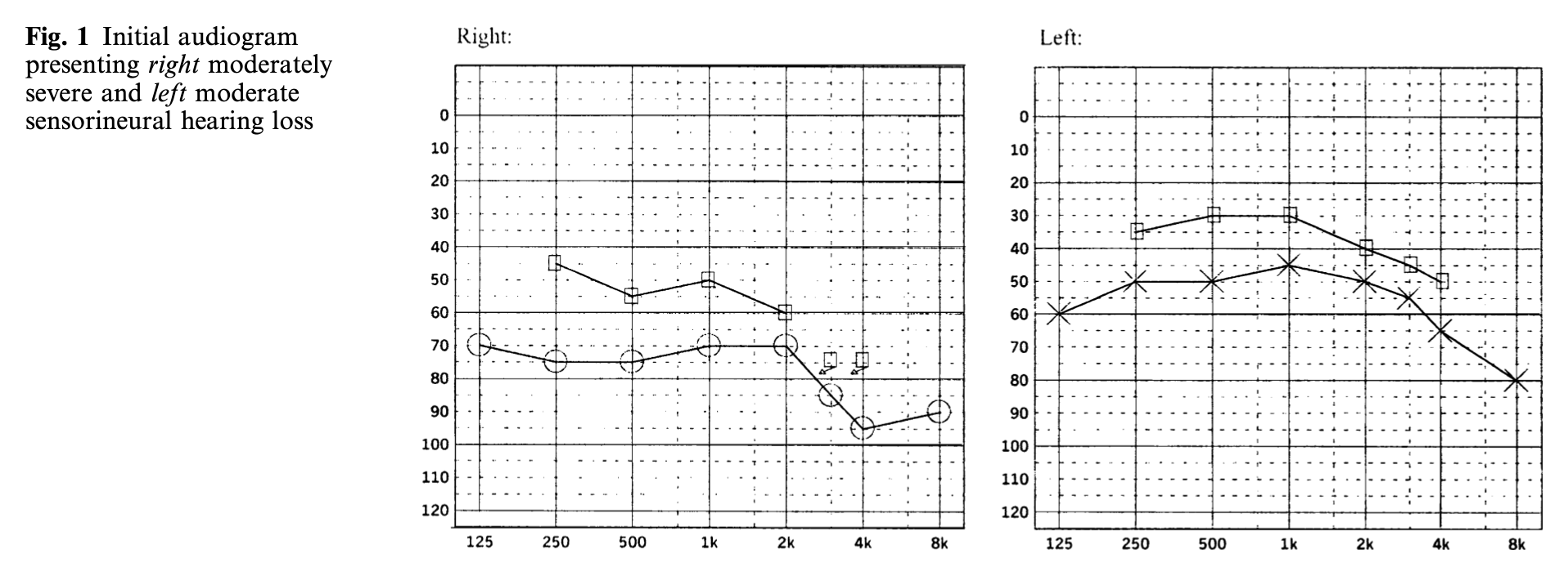Figure: Audiometry showing bilateral hearing loss in a case of otosyphilis.  From Song et al. (2005).