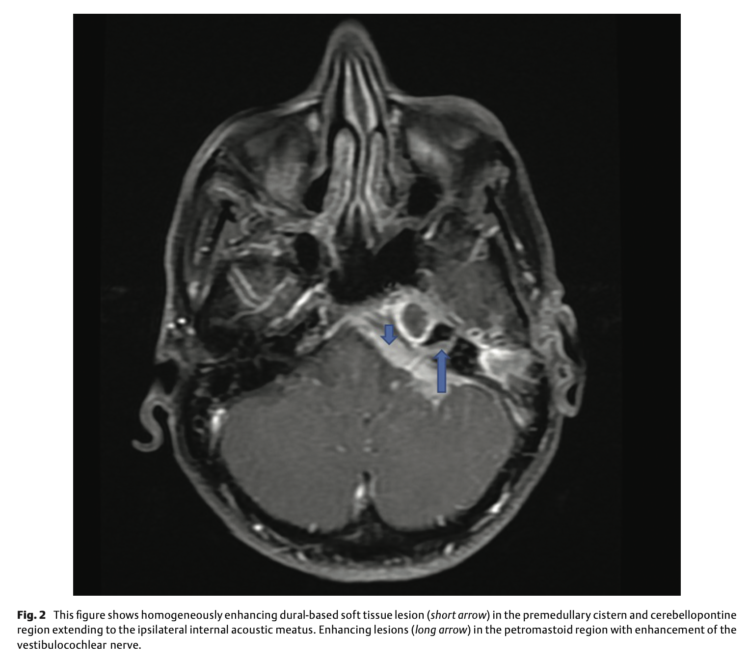 Figure: Axial MRI through the internal auditory canals showing a space-occupying lesion of the pre medullary cistern and cerebellopontine angle region extending to the internal acoustic meatus.  From Chandrasekharan et al. (2022).