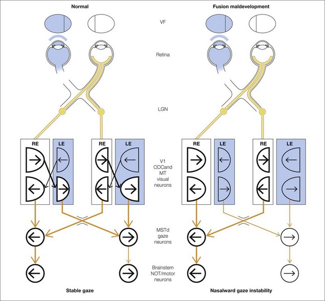Figure: Comparison of visual input and ocular motor output in a normal patient versus a patient with latent nystagmus.  From Tychsen et al. (2010).