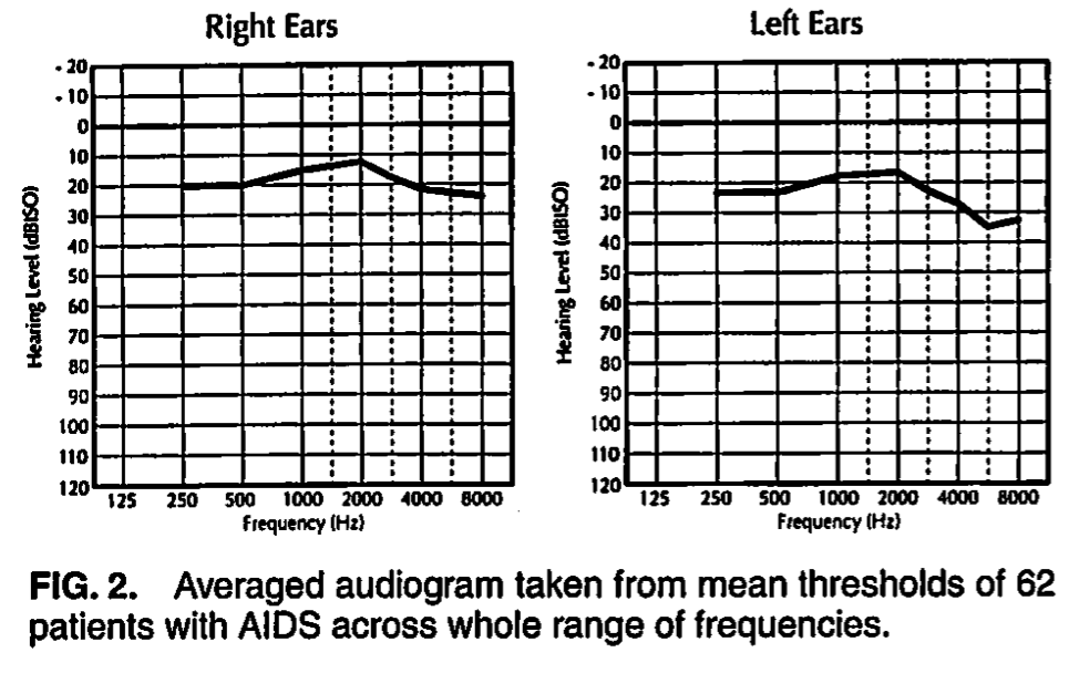 Figure: Composite audiogram from 62 AIDS patients.  From Soucek and Michaels (1996).
