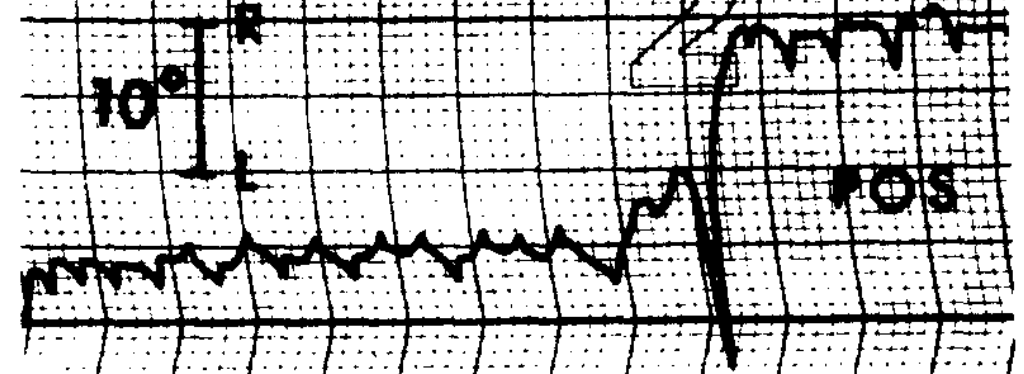 Figure: Congenital nystagmus.  Bidirectional nystagmus.  From Dell'Osso and Daroff (1975).